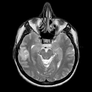 Señal hiperintensa T2 correspondiente a sangrado agudo.
