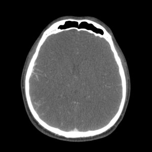 Se observan vasos sinuosos en la convexidad parietal derecho que corresponden a Colaterales. Comparar con la convexidad derecha donde no existen.