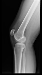 Pequeño fragmento óseo escleroso, bien definido, con que corresponde a un defecto de osificación del tubérculo tibial. No debemos confundir con rotura.