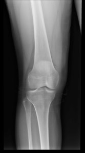 Radiografía en proyeccióna anteroposterior en la que aparentemente no vemos hallazgos de significación.