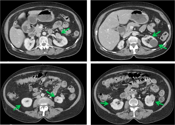 Se observan multiples lesiones en ambos riñones, casi todas inferiores a 3 cm.