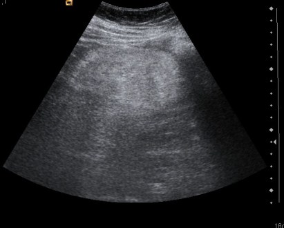 Imagen hiperecoica que ocupa la práctica totalidad de riñón.