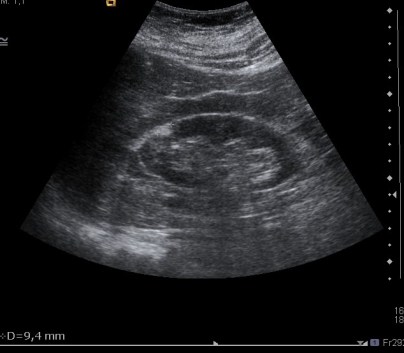 Imagen nodular hiperecoica en polo superior del riñón derecho.