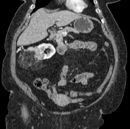 Reconstrución coronal.