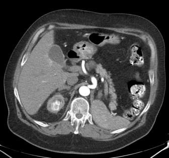 LOE en polo superior del RD que realza con la administración de civ en fase corticomedular.