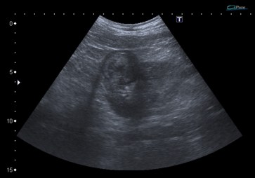 Masa heterogénea, en forma de bola, de 3.5 x 3.5 cm aprox. Hay que descartar un proceso maligno.