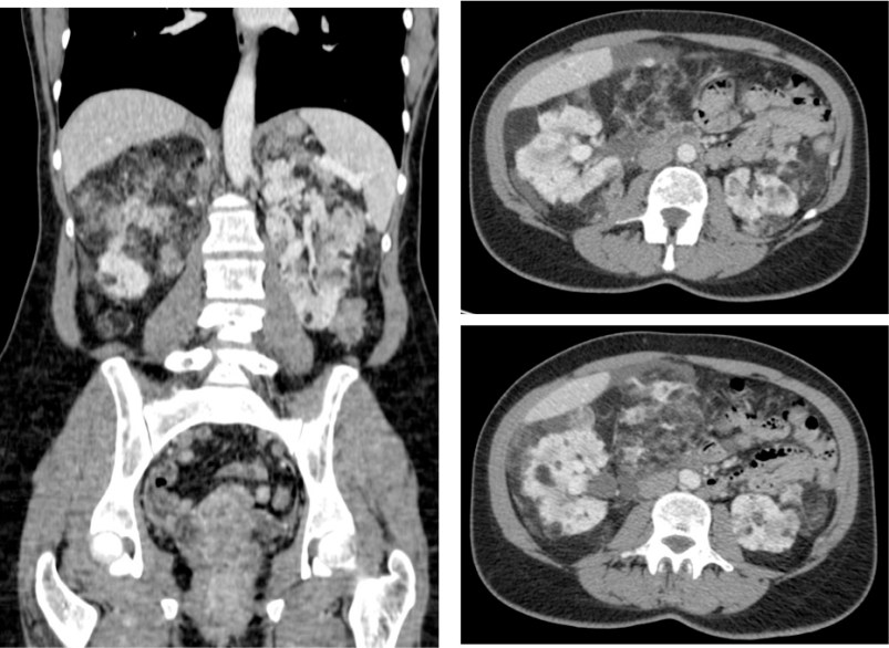 Se observan en los cortes axilaes múlples angiomiolipomas bilaterales con grasa macroscópica. Existe una gran lesión, más evidente en la reconstrucción coronal, que prácticamente engloba todo el riñón derecho que llegaba casi hasta pelvis renal. Se trataba de un AML gigante.