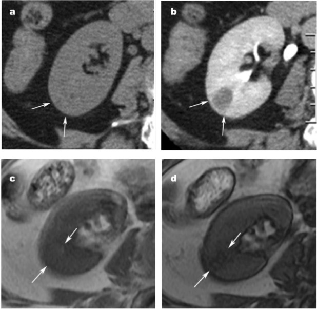 a) Isoatenuado en TC sin civ b) Realce homogéneo en TC con civ c) Hiperintenso en Fase d) Caída de señal en Fase Opuesta y fenómeno de tinta china.