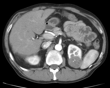 Lesión hipoatenuada en fase corticomedular con una calcificación central.