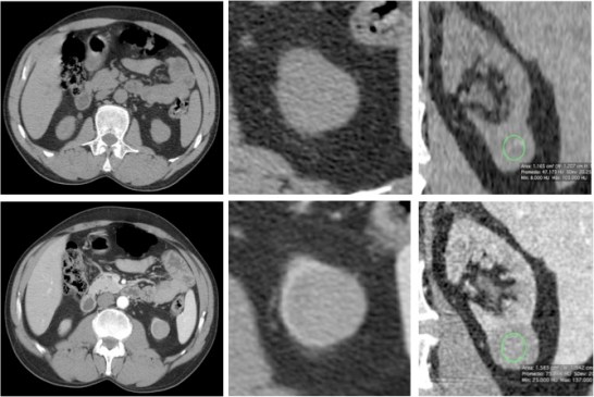 Arriba TC sin contraste, Abajo TC contrastado. EL carcinoma papilar es hipatenuado en TC sin contraste y presenta un poco realce tras la administración del mismo. Diferente al CCR de células claras.
