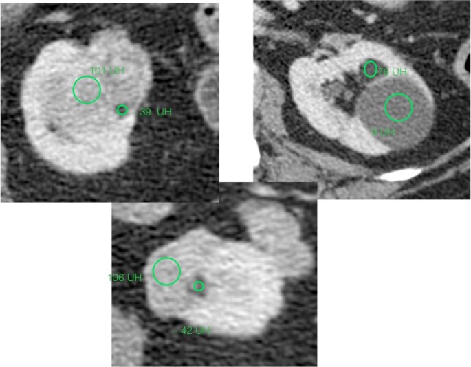 Realizamos multiples mediciones con ROI y encontramos áreas con densidad negativa, indicativa de grasa macroscópica = angiomiolipoma.