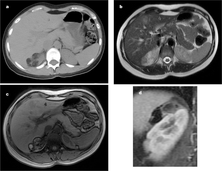 a) Lesión con grasa macroscópica en polo superior rinón aunque tambien podría tener origen renal b) y c) Señal en fase con caída de señal en fase opuesta, lo cual indica presencia de grasa, aunque ve heterogénea dicha señal. d) Peak sign, el origen de la lesión es renal.