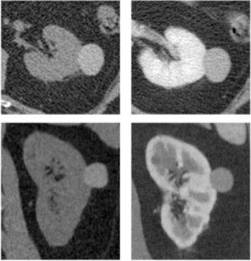 La importancia del patrón de realce.  Quiste hiperdenso se define como alquel quiste que tiene un realce en TC sin contraste alrededor de 85 UH y que tras la administración de contraste no posee un cambio significativo. De este modo podemos decir que no se trata de un CCR