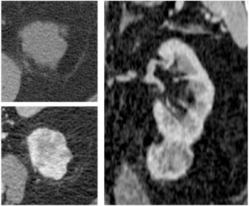 La importancia del patrón de realce.  Lesión en polo inferior del RI que tiene un cambios de realce significativo entre un TC sin contraste y un TC en fase nefrográfica. Diagnóstico de CCR probablemente de células claras.