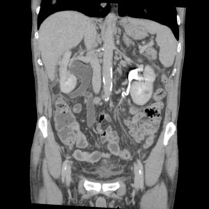 Reconstrucción coronal. Dilatación del uréter dreecho.