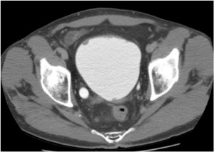 Se le realiza una Uro TC de control al año y se encuentran masas focales con defecto de repleción, indicativo de recidiva tumoral que fueron extraídas por cirugia RTU.