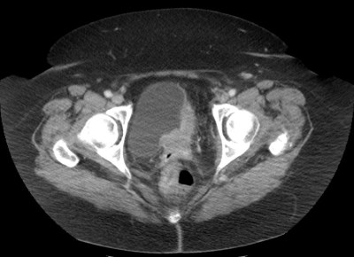 Se confirma la existencia de una masa en la pared vesical que se realza con la administración de contraste, la masa atraviesa la pared de la vejiga e invade peritoneo y colon.