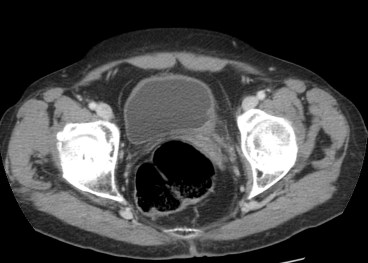 Tumor vesicual tras RTU. SE observan cambios inflamatorios de modo asimétrico e irregular que simulan un proceso neoformativo y pueden llevarnos a confución.