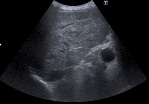 Hígado heretogéneo con imagnes compatibles con LOE.