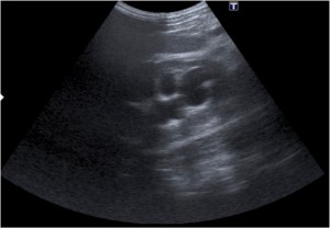 Ectasia severa en riñón derecho.
