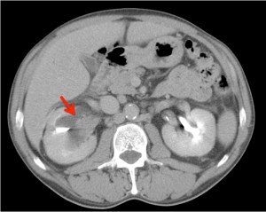Tumor metacrónico en pelvis renal derecha.