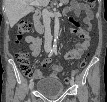 Reconstrucción coronal.