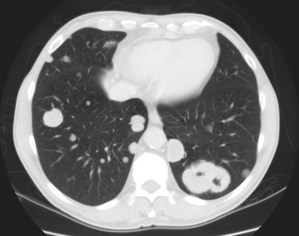 Nódulos pulmonares bilaterales, algunos cavitados, compatibles con metástasis por Cáncer de tipo Transicional Urotelial.