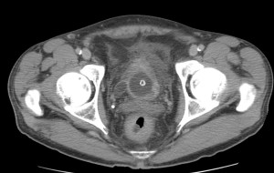 Vejiga sondada con dilatación del uréter distal derecho.
