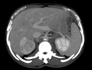 Reconstrucción con MIP. Se observa una oclusión de la vena porta derecha por trombosis de la misma.
