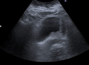 Se observa una masa vesical en la pared posterior.