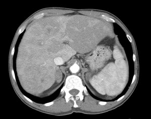 Híagado heretogéneo con defectos de perfusión.