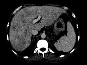 LOE en ambos LH, metástasis.