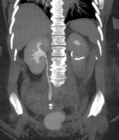 Reconstrucción coronal. Anulación funcional del riñon izquierdo donde se ha realizado una nefrostomía. Tambien se viasualiza una hidronefrosis moderada en riñón derecho que llega hasta la vejiga.