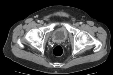 Engrosamiento irregular y asimétrico que en este caso también crresponde a proceso neofromativo.