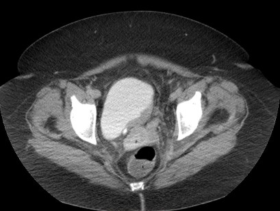Uro- TC en fase con contraste en fase excretora. Se observa el defecto de repelción vesical por la masa neoplásica.