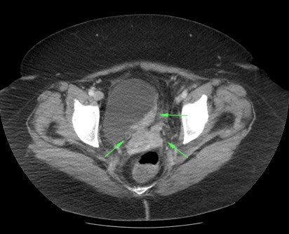La masa invade el cuello vaginal y no podemos descartar que también el recto. El ureter distal izquierdo no se visualiza y el derecho ha comenzado a distenderse.