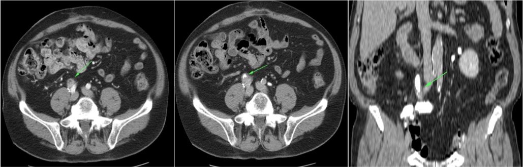 Bricker. Recidiva en el uréter derecho que va abocado al intestino delgado.