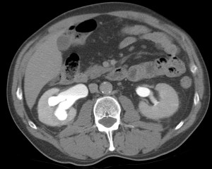 Hidroureteronefrosis severa en probable relación con fibrosis cicatricial tras la primera RTU.