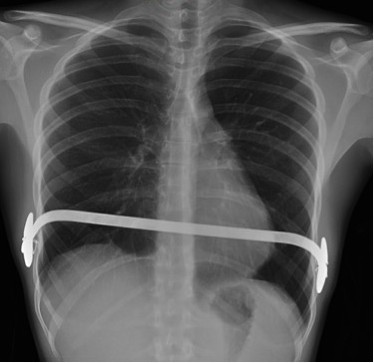 Barra de NUSS pot operatorio de pectus excavatum.