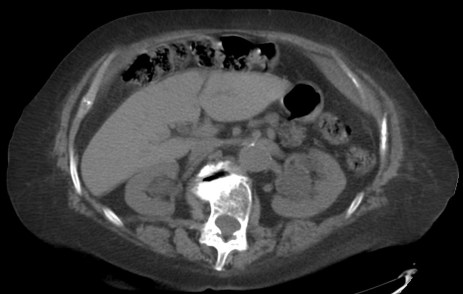 Colon interpuesto al hígado hipocondrio derecho.
