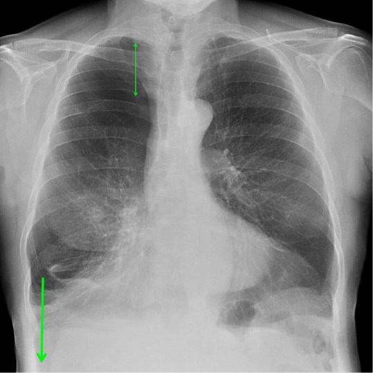 Seno profundo y ausencia de trama en LSD.