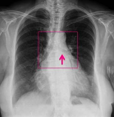 Bronquio izquierdo rectificado por crecimiento de la aurícula izquierda (signo de la bailarina).