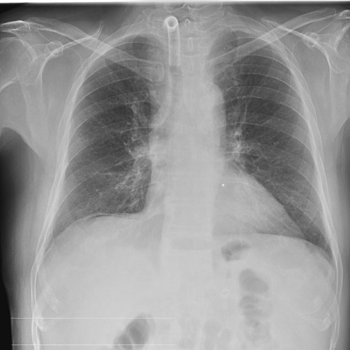 Aire subdiafragmático derecho, hallazgo compatible con neumoperitoneo.