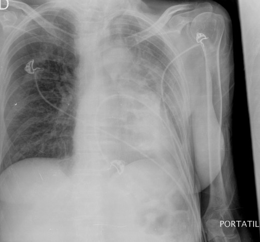 AP. Tórax portatil.
