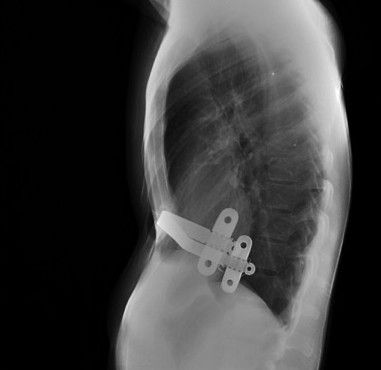 Barra de NUSS pot operatorio de pectus excavatum.