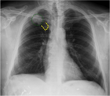 A diferencia del caso anterior, aquí observamos una opacidad nodular (verde) que no coincide con la articulación de la primera costilla con el esternón (amarillo) y daría la imagen de seudnódulo que comentamos en el caso precedente.