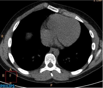 Corte Axial TC de Tórax donde se observa la deformidad anterior del esternon.