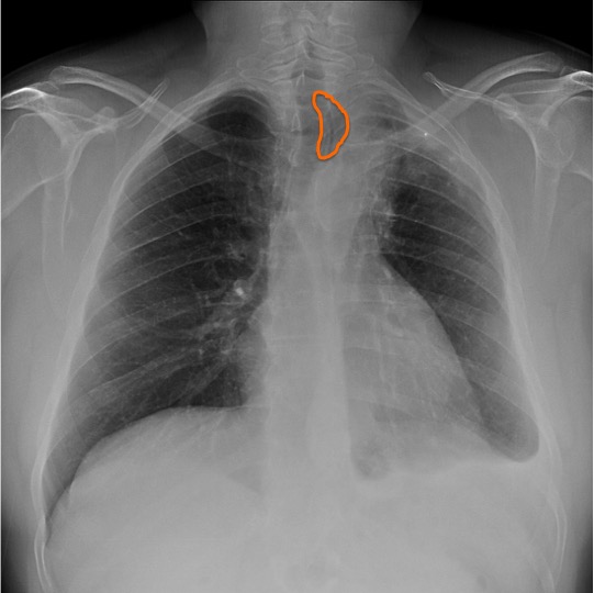 Signo de Luftsichel.