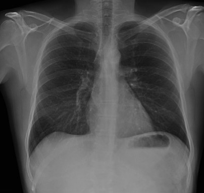 Hilio derecho normal.