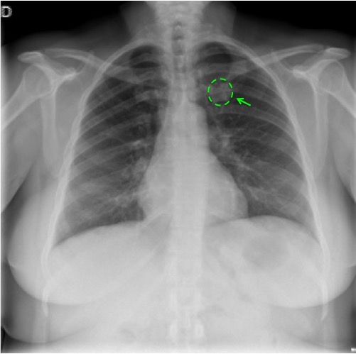 Seudnódulo primera costilla.